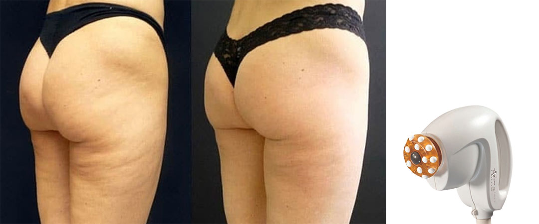 Results from the Alma Accent Prime cellulite reduction package.