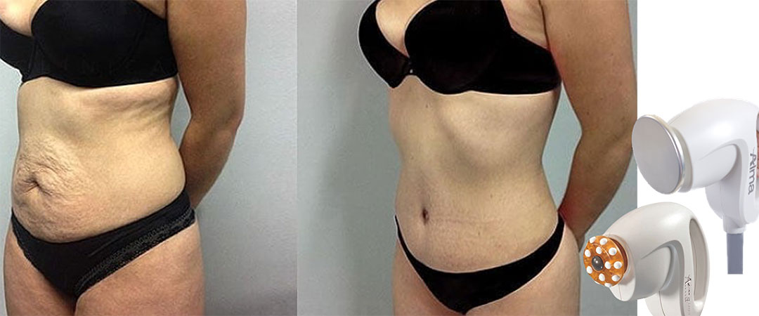 Results from the Alma Accent Prime skin tightening package.