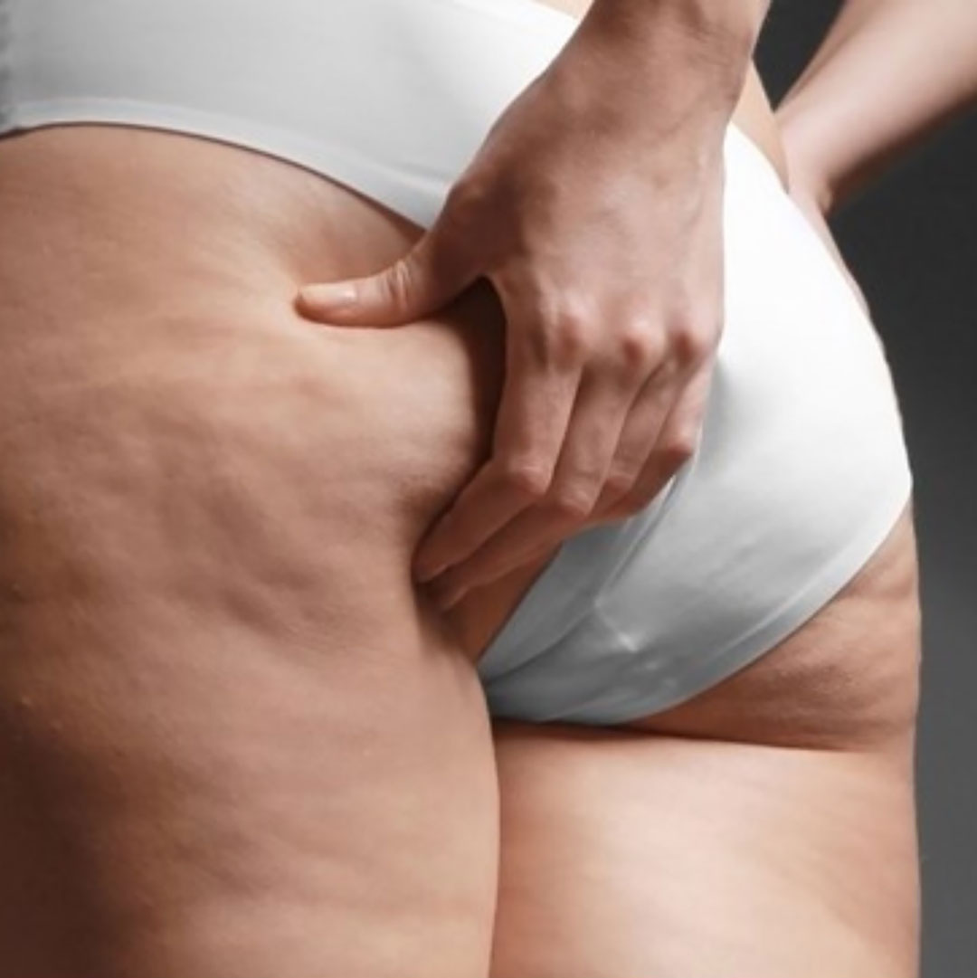 What causes Ozempic butt?