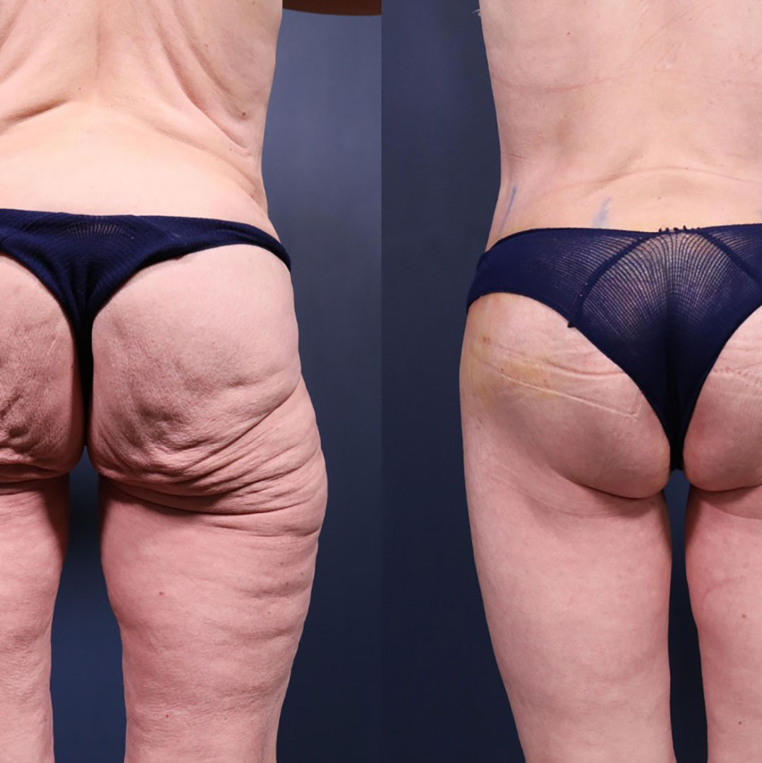 Why some people get Ozempic butt and others don’t