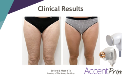 The Latest in Non-Invasive Body Sculpting on the Gold Coast: What’s New, What Works, What’s Next